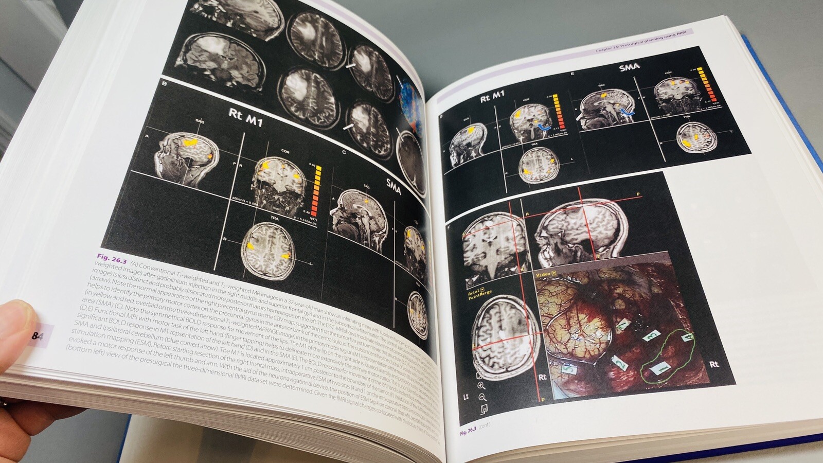 Clinical MR Neuroimaging Physiological and Functional Techniques Gillard Waldman