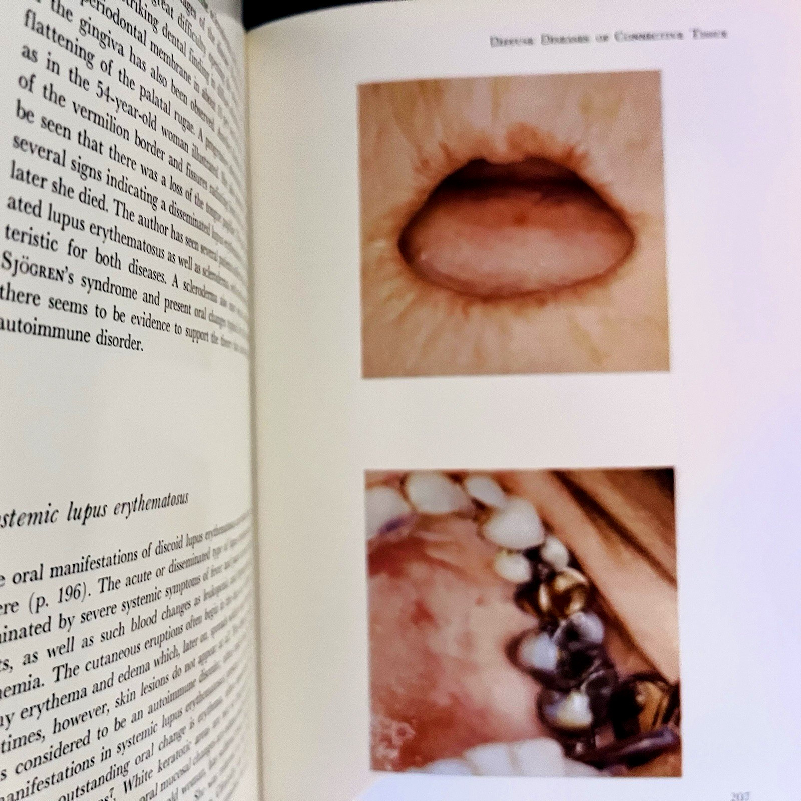 Atlas of Diseases of the Oral Mucosa Book Hardcover J. J. Pindborg 1973