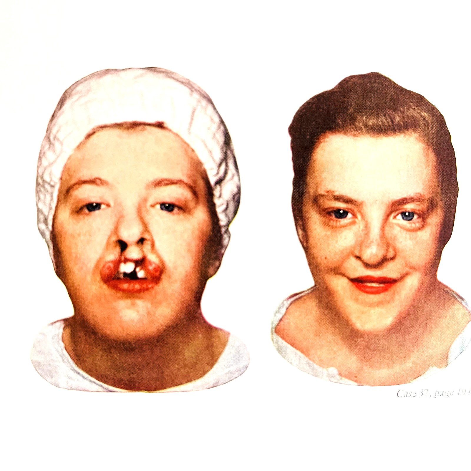 Vintage Plastic and Reconstructive Surgery 3rd Edition Book Hardcover 1971 Hans