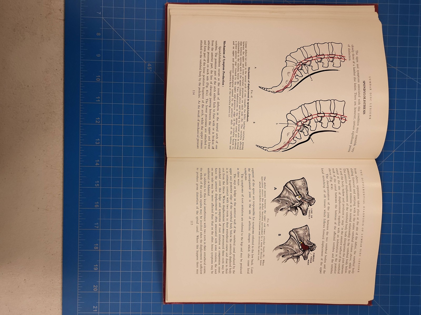 J R Armstrong Lumbar Disc Lesions 1958 Hardcover Second Edition Spine Sciatica