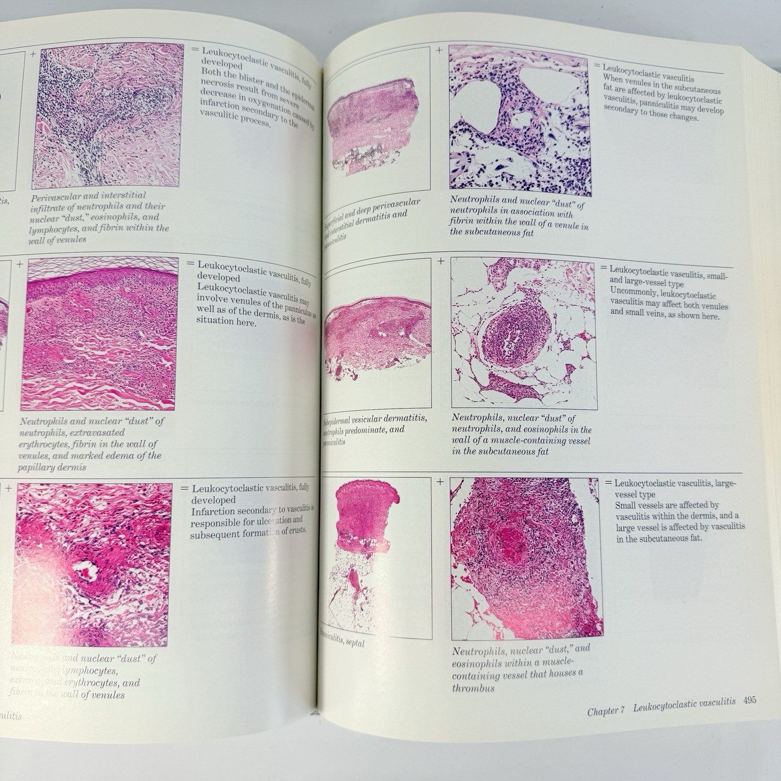 Histologic Diagnosis of Inflammatory Skin Diseases 2nd Ed Ackerman + Algorithms