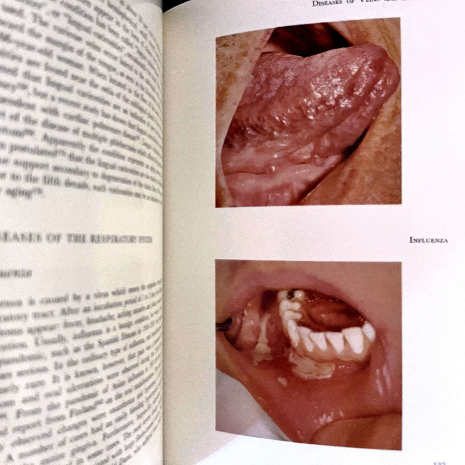 Atlas of Diseases of the Oral Mucosa Book Hardcover J. J. Pindborg 1973
