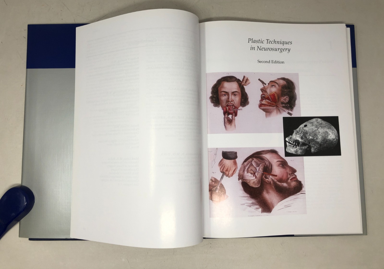 Plastic Techniques in Neurosurgery, 2004, E-122