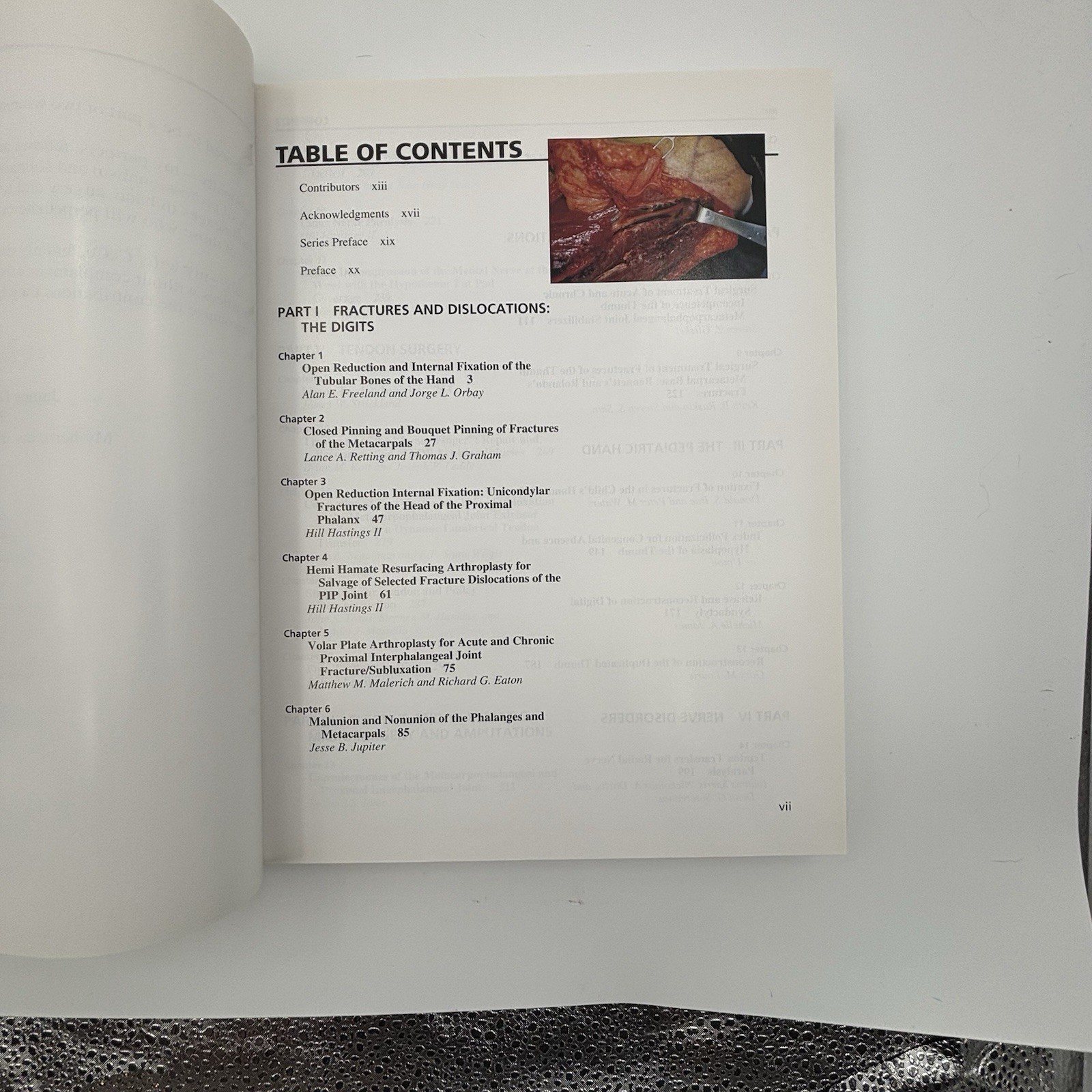 Master Techniques In Orthopaedic Surgery: The Hand by James W. Stickland