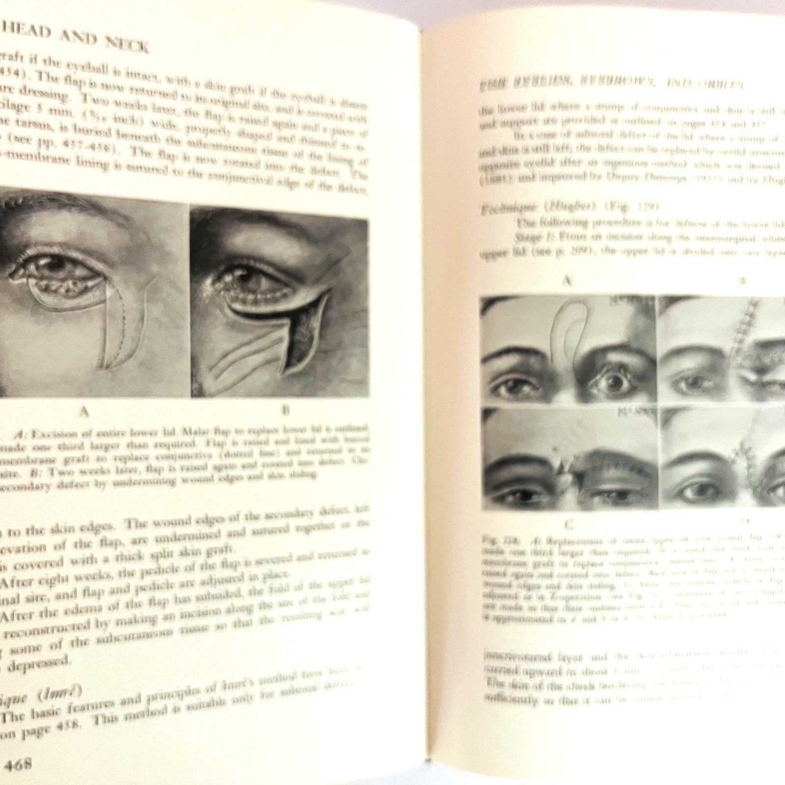 Vintage Plastic and Reconstructive Surgery 3rd Edition Book Hardcover 1971 Hans