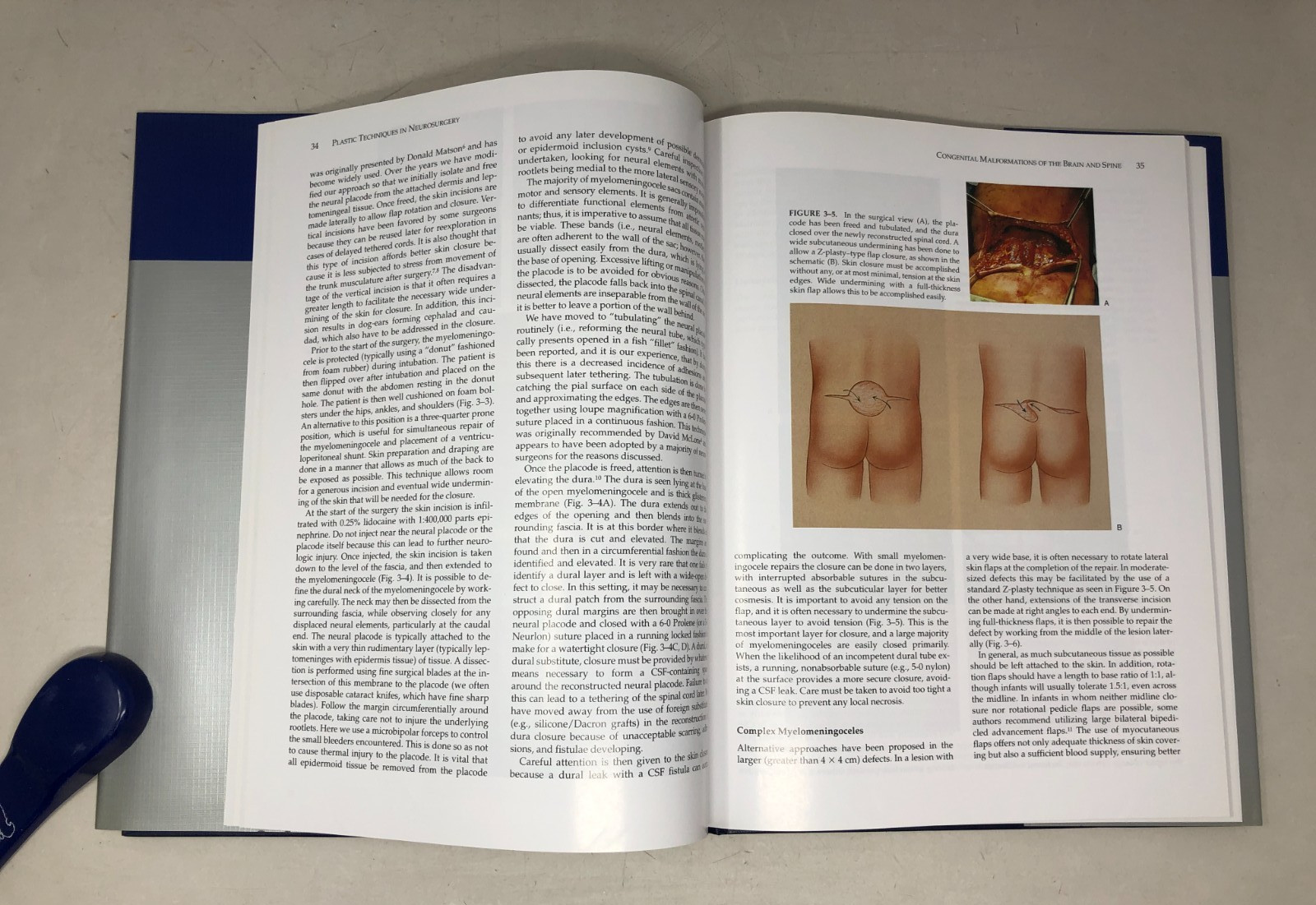 Plastic Techniques in Neurosurgery, 2004, E-122