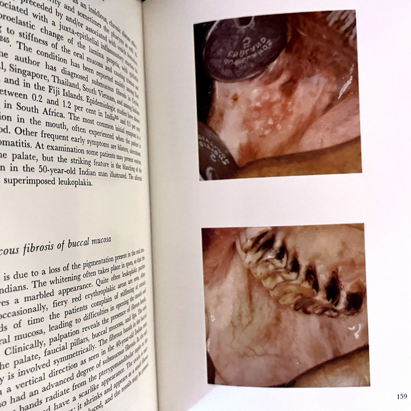 Atlas of Diseases of the Oral Mucosa Book Hardcover J. J. Pindborg 1973