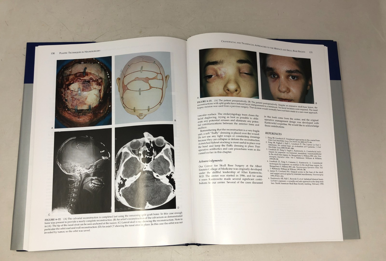 Plastic Techniques in Neurosurgery, 2004, E-122