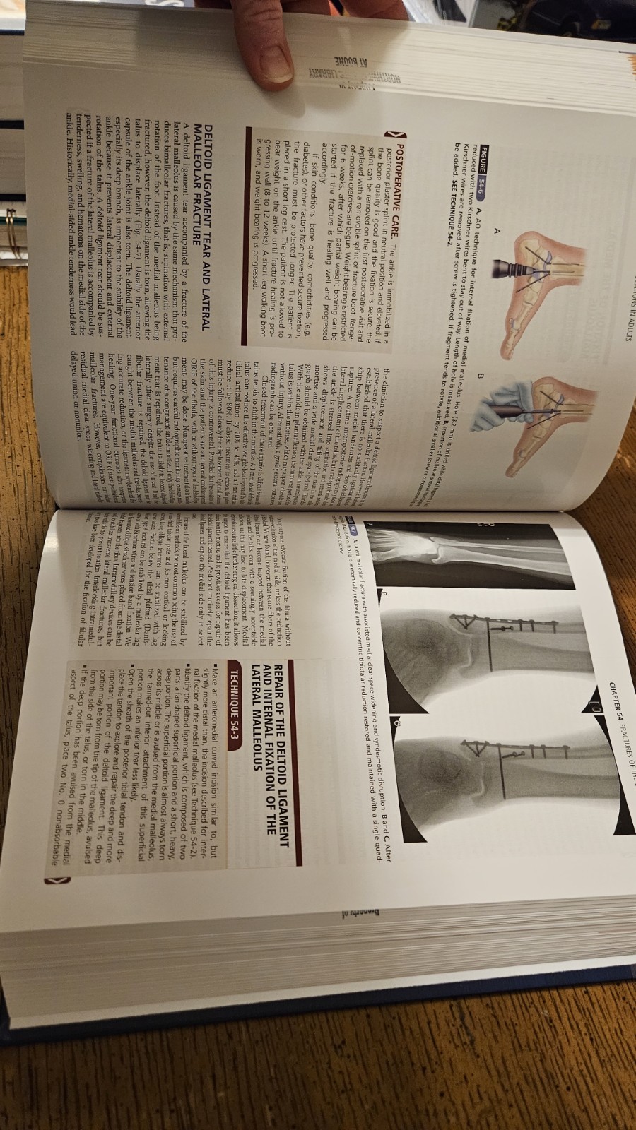 Campbell’s Operative Orthopaedics, 4-Volume Set by S. Terry Canale, James H….
