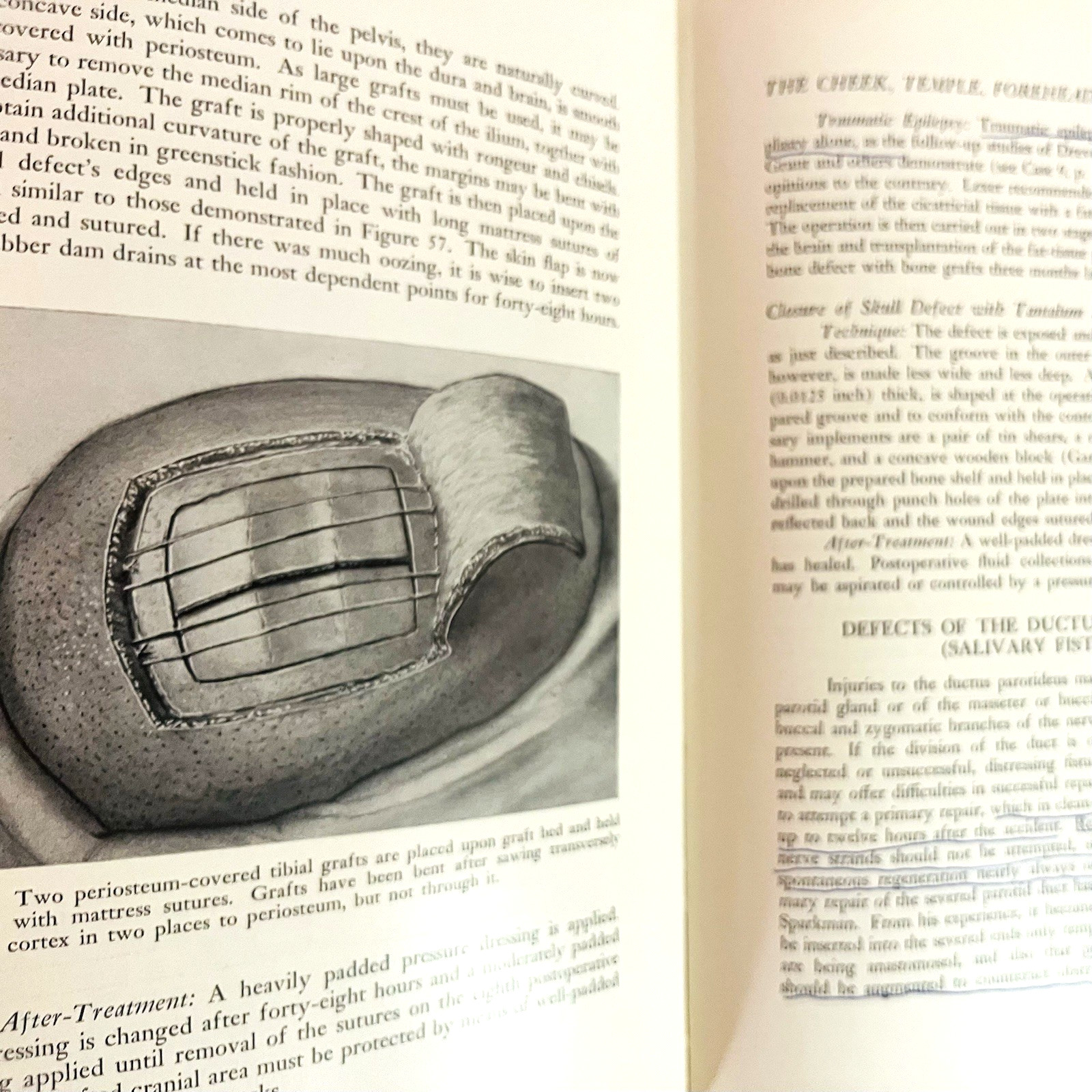 Vintage Plastic and Reconstructive Surgery 3rd Edition Book Hardcover 1971 Hans